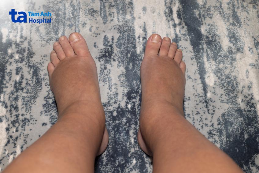 Chế độ ăn lành mạnh giúp kiểm soát phù nề