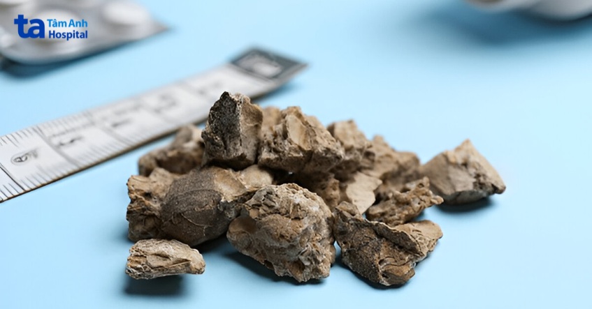 Sỏi niệu đạo có thể hình thành ở niệu đạo