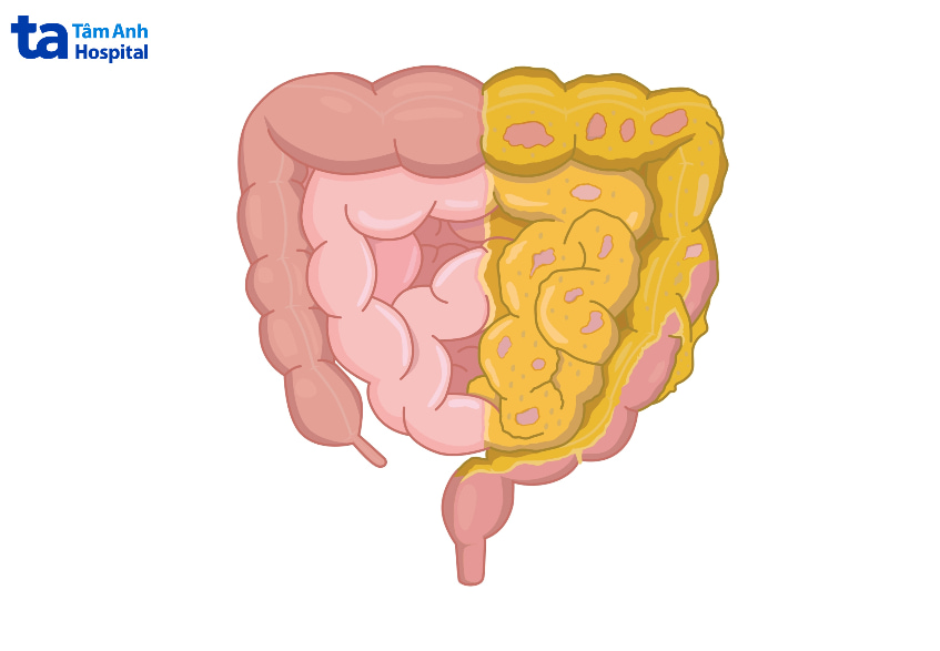 Lợi ích của bơ trong việc kiểm soát cân nặng