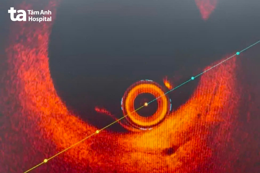 Ảnh chụp cắt lớp kết quang nội mạch cho thấy lớp bóc tách nội mạch vành