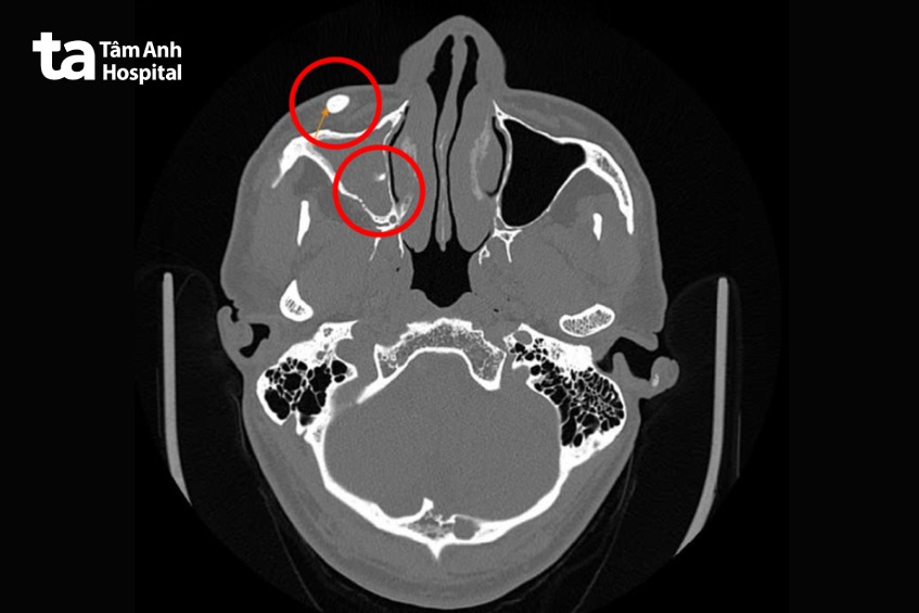 ảnh ct dị vật vùng má