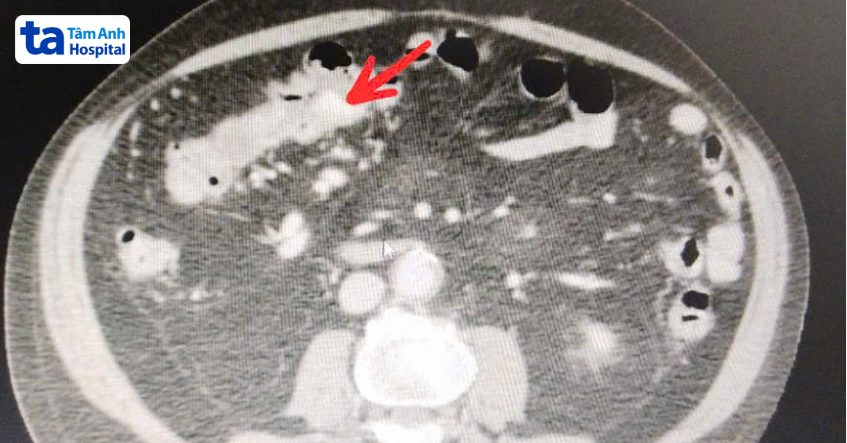 ảnh ct khối dị dạng