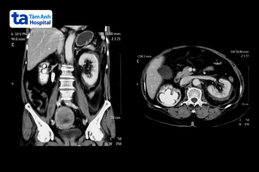 ảnh chụp CT túi mật