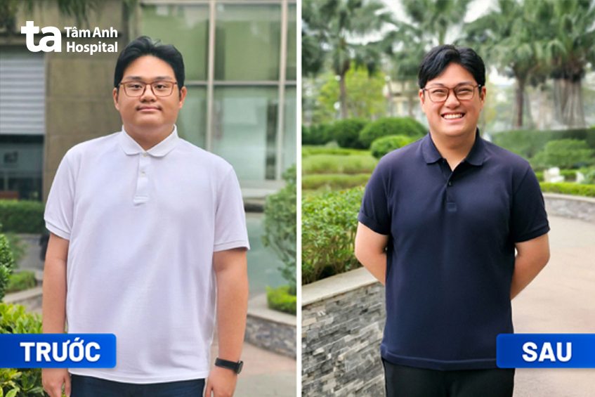 anh hà trước và sau giảm cân tại tâm anh