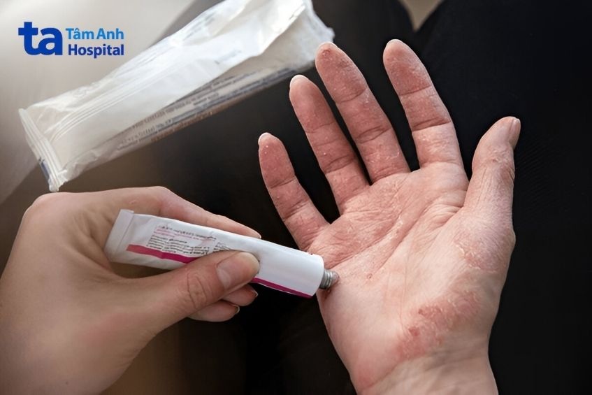 bác sĩ có thể kê thuốc bôi giúp da hồi phục nhanh