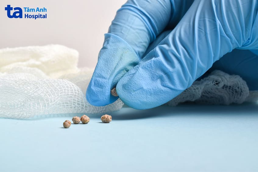 bác sĩ phuật thuật mở để bỏ sỏi bàng quang kích thước lớn hơn 4cm