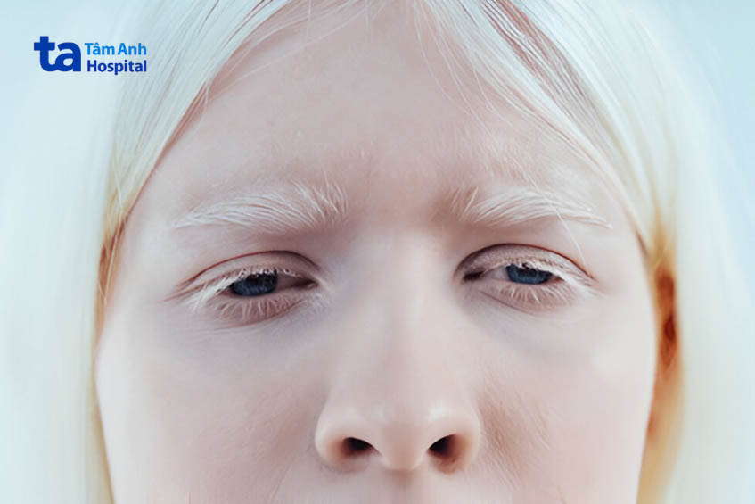 Bệnh bạch tạng ảnh hưởng đến mắt