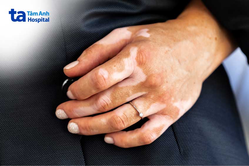 bệnh bạch biến là gì