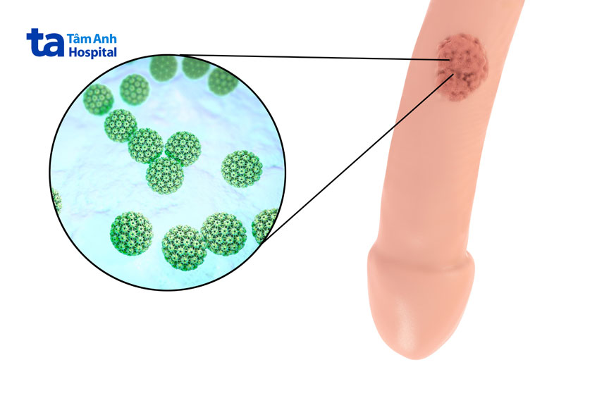 bệnh có thể lây trong thời gian ủ bệnh