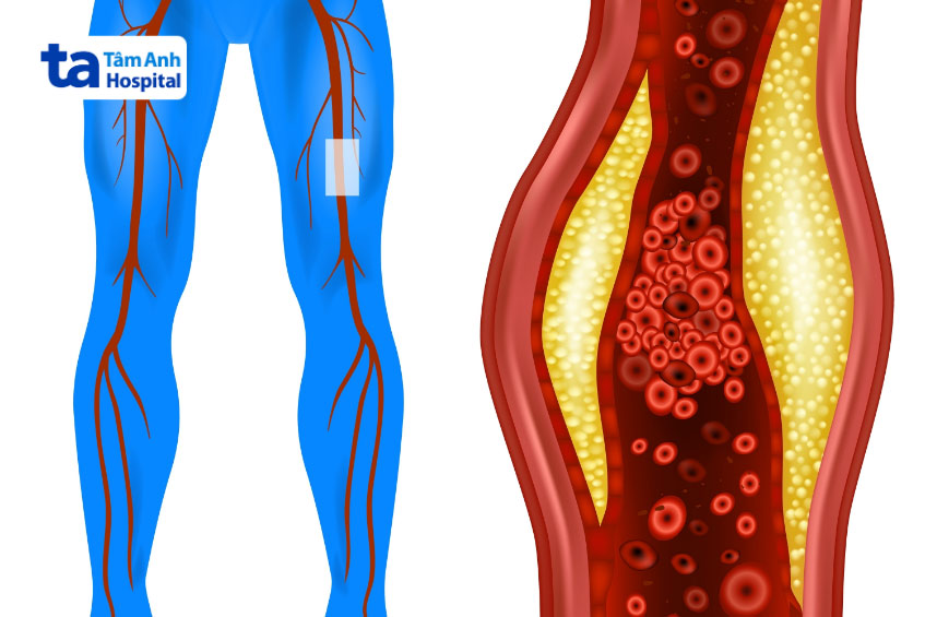 Bệnh động mạch ngoại biên là nguyên nhân cao thứ ba gây tử vong liên quan đến bệnh tim mạch