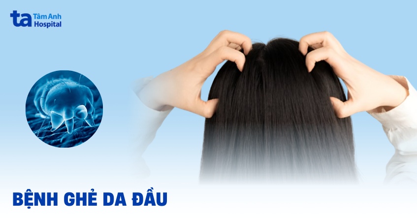 bệnh ghẻ da đầu