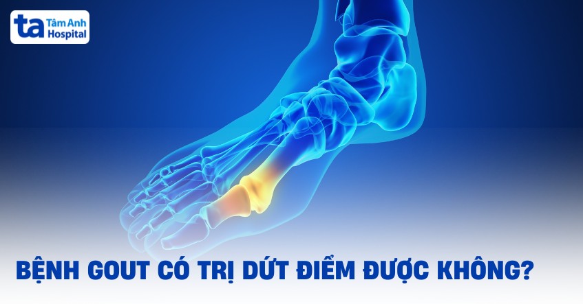 Bệnh gout có trị dứt điểm được không? Cách điều trị hiệu quả
