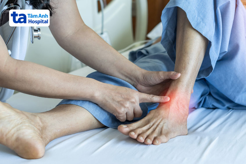 Bệnh gout gây viêm khớp vùng mắt cá chân