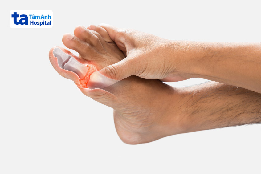 Bệnh Gout thường ảnh hưởng đến ngón chân