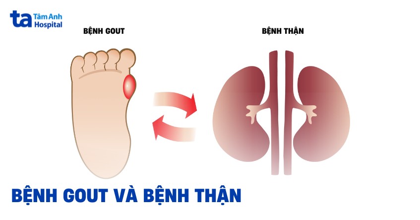 Bệnh gout và bệnh thận: Mối liên hệ mật thiết có thể bạn chưa biết