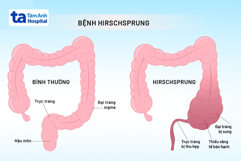 bệnh hirschsprung khiến khí và phân bít tắc bên trong ruột