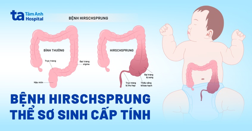 bệnh hirschsprung thể sơ sinh cấp tính