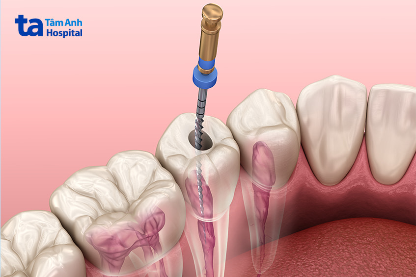 Bệnh lý tủy răng là gì?