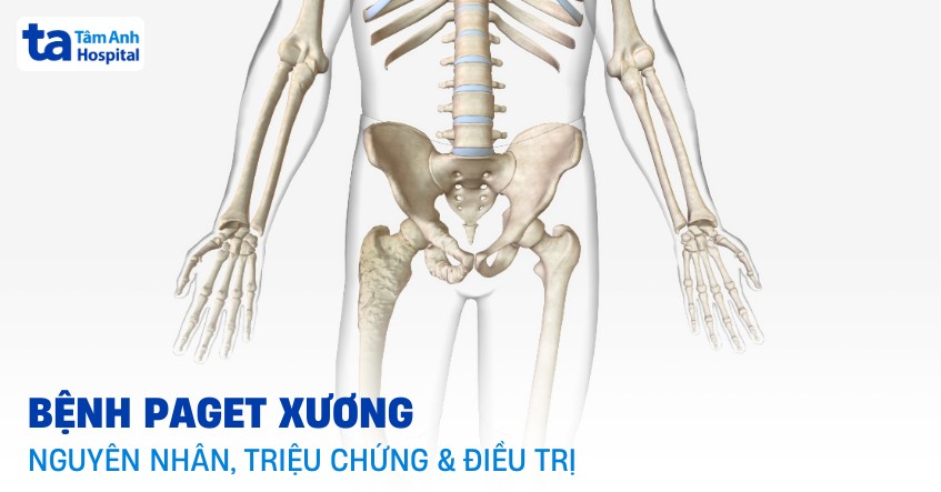 Bệnh Paget xương là gì? Nguyên nhân, triệu chứng và điều trị