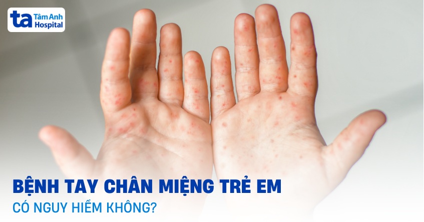 Bệnh tay chân miệng trẻ em có nguy hiểm không? Ảnh hưởng gì?