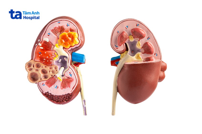 bệnh thận tăng nguy cơ gút và tiểu đường