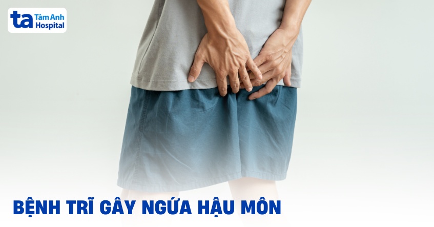 Bệnh trĩ gây ngứa hậu môn: Nguyên nhân, triệu chứng và phòng ngừa
