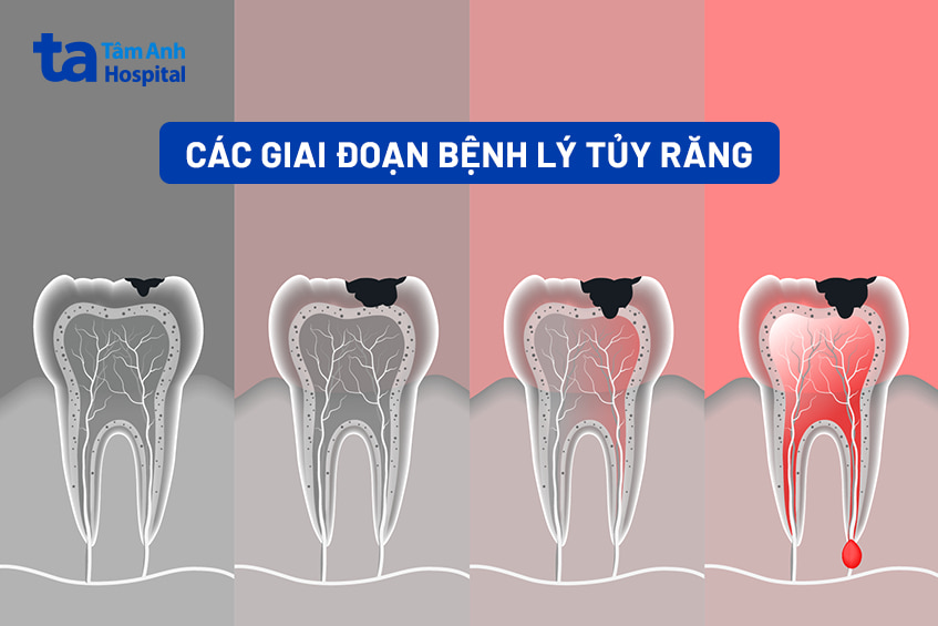Các bệnh lý tủy răng thường gặp