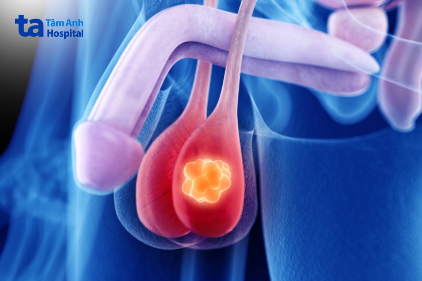 bệnh ung thư tinh hoàn chữa được không