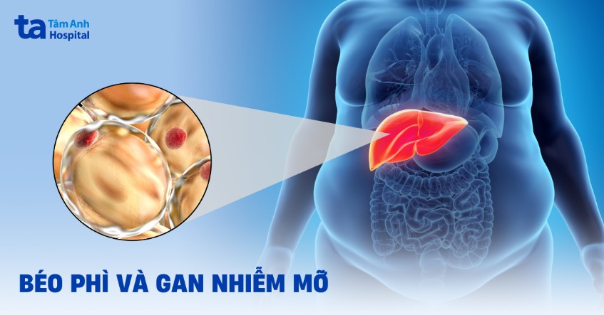 béo phì và gan nhiễm mỡ