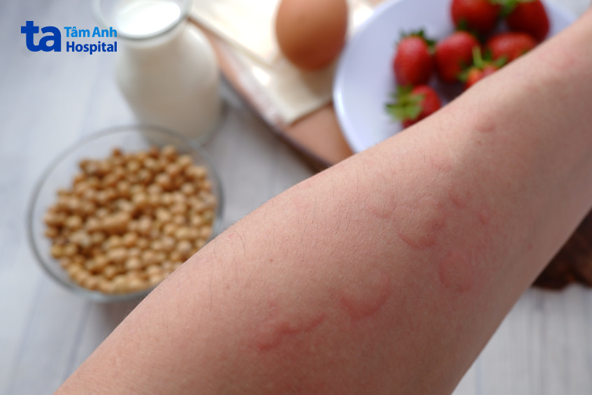 Vai trò của chế độ ăn uống trong việc kiểm soát viêm da tiếp xúc