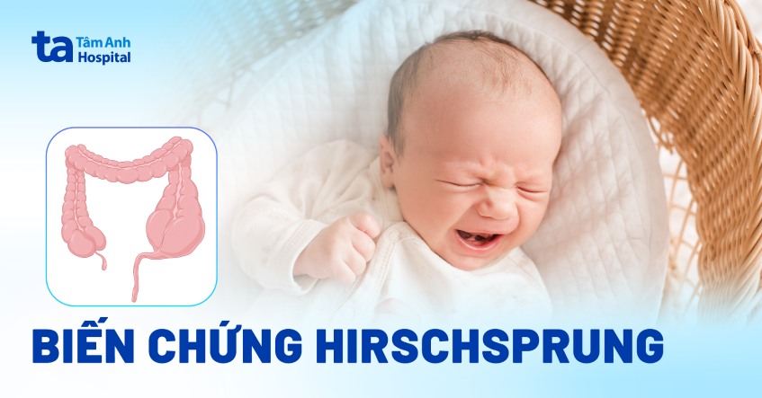 Biến chứng Hirschsprung nguy hiểm nhận biết sớm để phòng ngừa