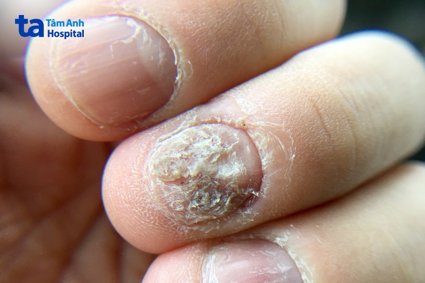 biến chứng nấm móng tay