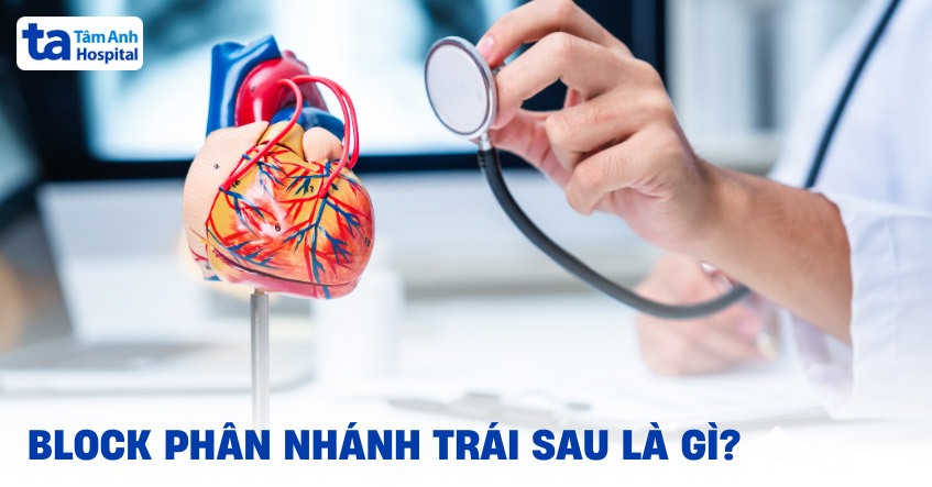 Block phân nhánh trái sau: Nguyên nhân, chẩn đoán và điều trị