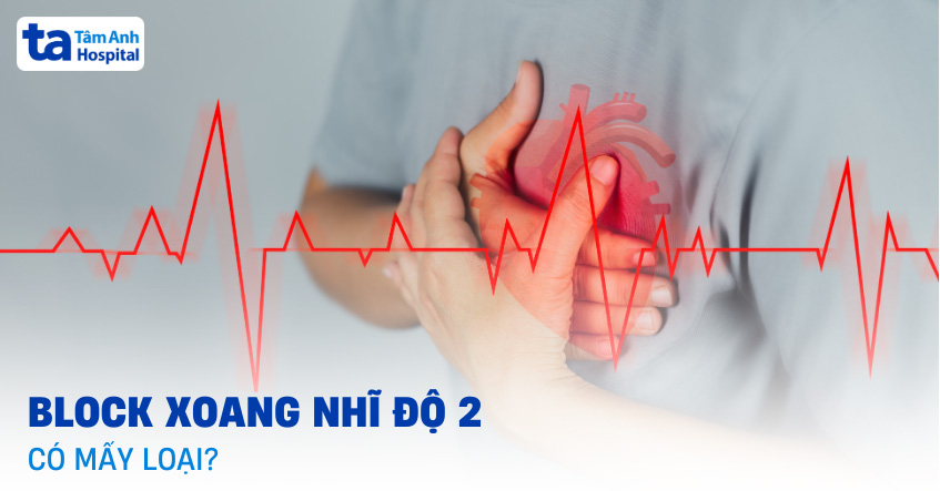 Block xoang nhĩ độ 2 có mấy loại? Chẩn đoán và cách điều trị