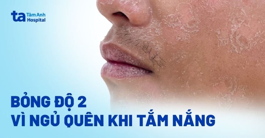 bỏng độ 2 vì ngủ quên khi tắm nắng