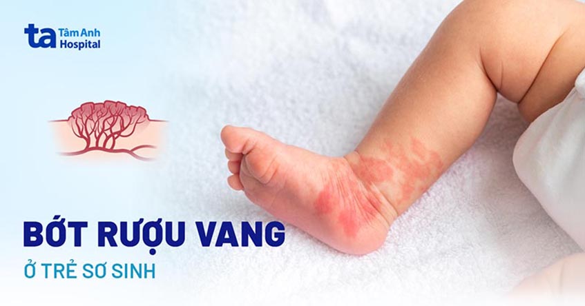 Bớt rượu vang ở trẻ sơ sinh: Nguyên nhân, ảnh hưởng và điều trị