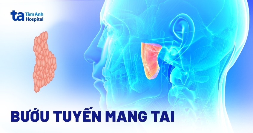bướu tuyến mang tai