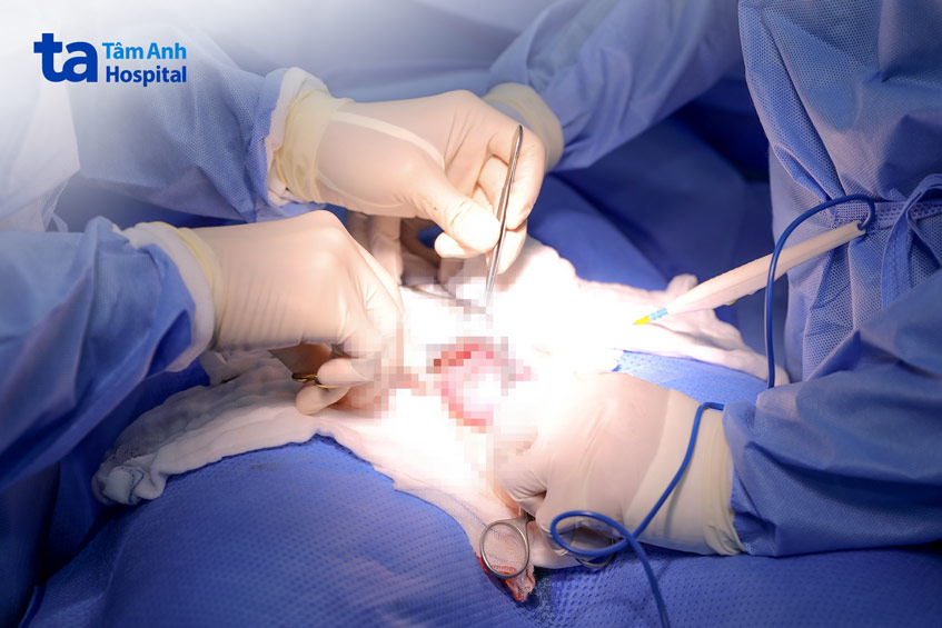 Các bác sĩ vi phẫu micro-TESE thông nối ống dẫn tinh cho người bệnh