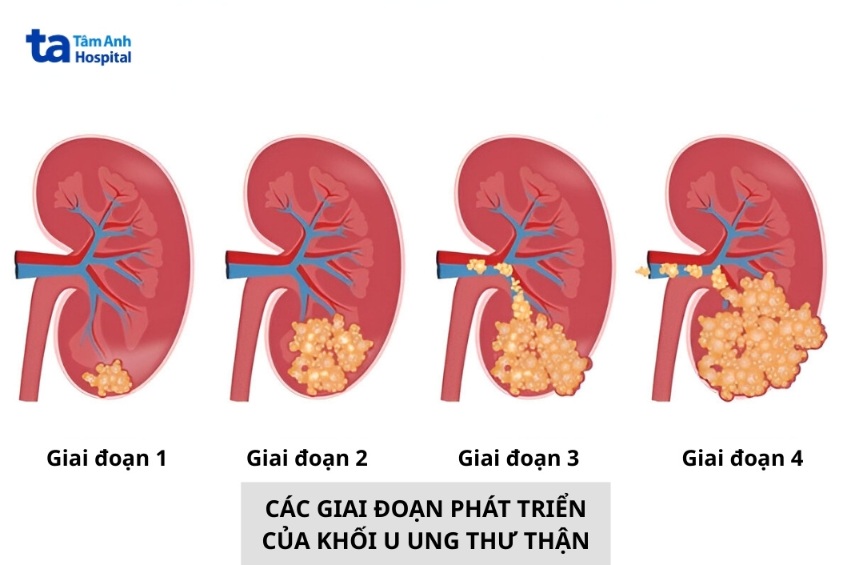 các giai đoạn phát triển của khối u ung thư thận