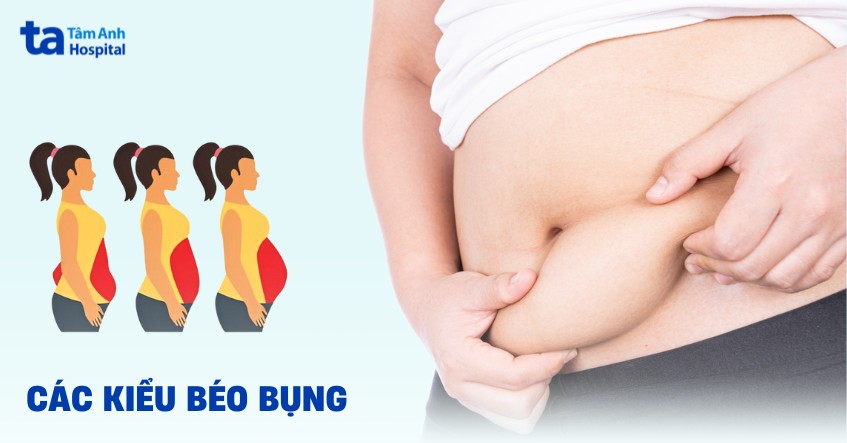 các kiểu béo bụng