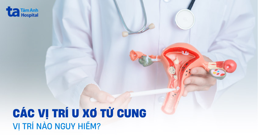 Các vị trí u xơ tử cung thường nằm ở đâu? Chỗ nào nguy hiểm?
