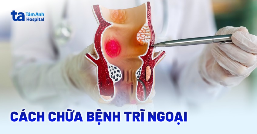 Top 7 cách chữa bệnh trĩ ngoại hiệu quả và an toàn hiện nay