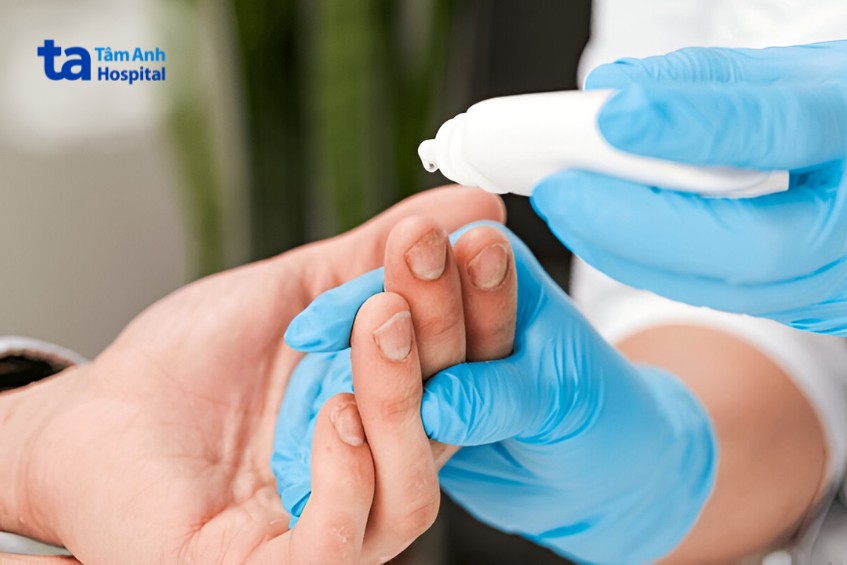 cách chữa trị nấm kẽ móng tay