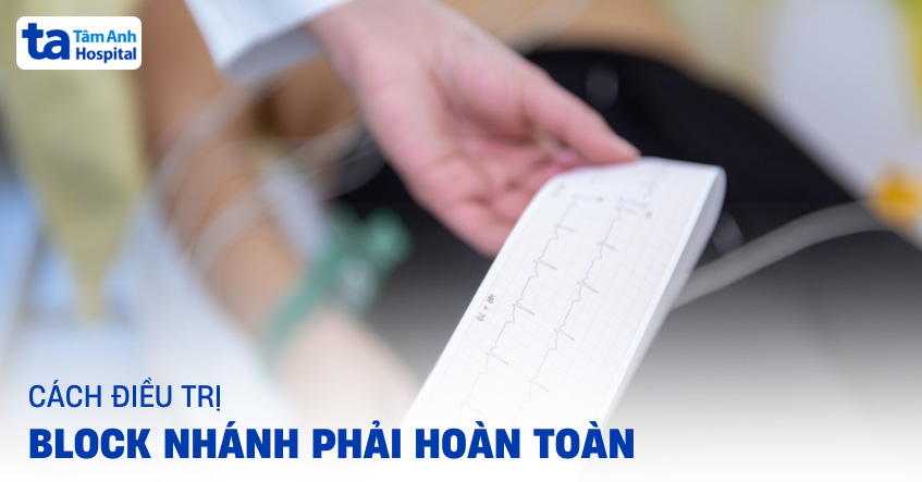 3 cách điều trị block nhánh phải hoàn toàn phổ biến và hiệu quả