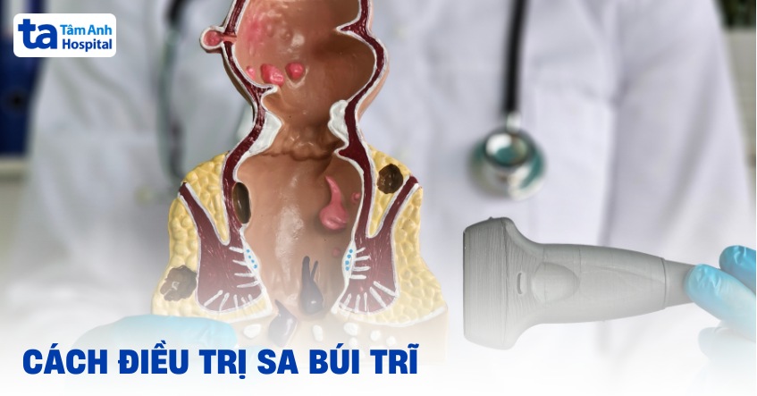 8 cách điều trị sa búi trĩ hiệu quả đang được áp dụng phổ biến