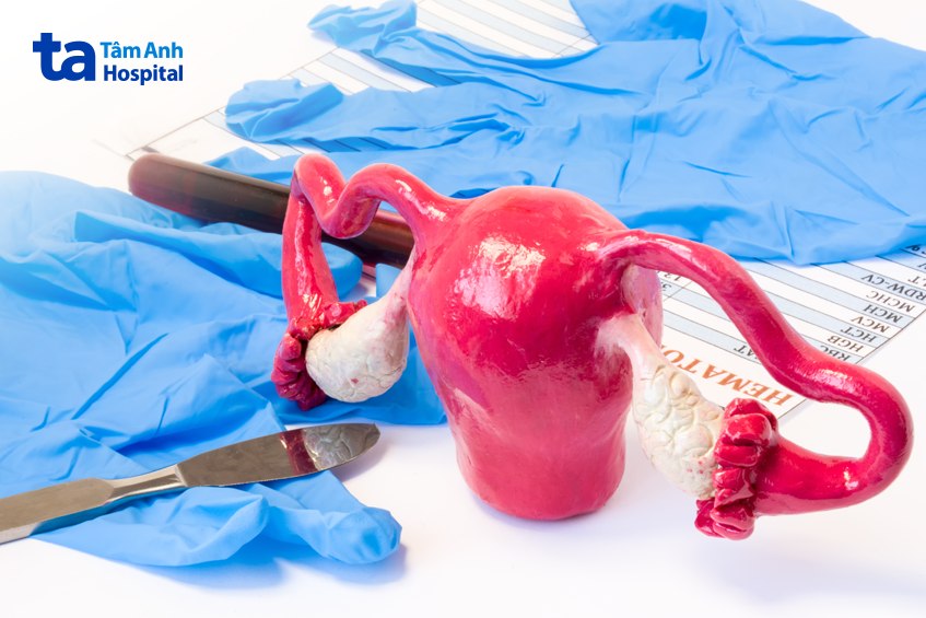 cân nhắc phẫu thuật k đại tràng di căn buồng trứng