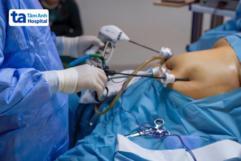 cắt túi mật làm giảm tuổi thọ không