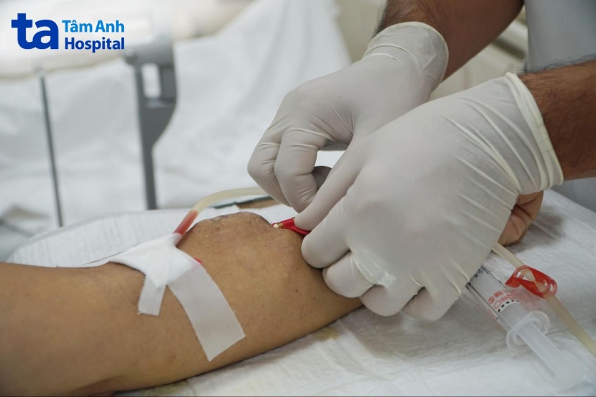 cầu tay của 1 người bệnh chạy thận nhân tạo chu kỳ