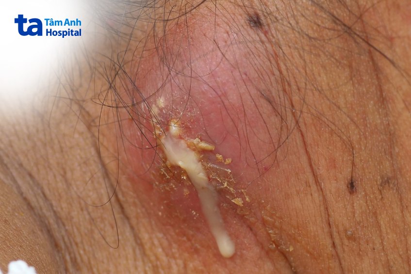 chảy mủ biến chứng lao hạch
