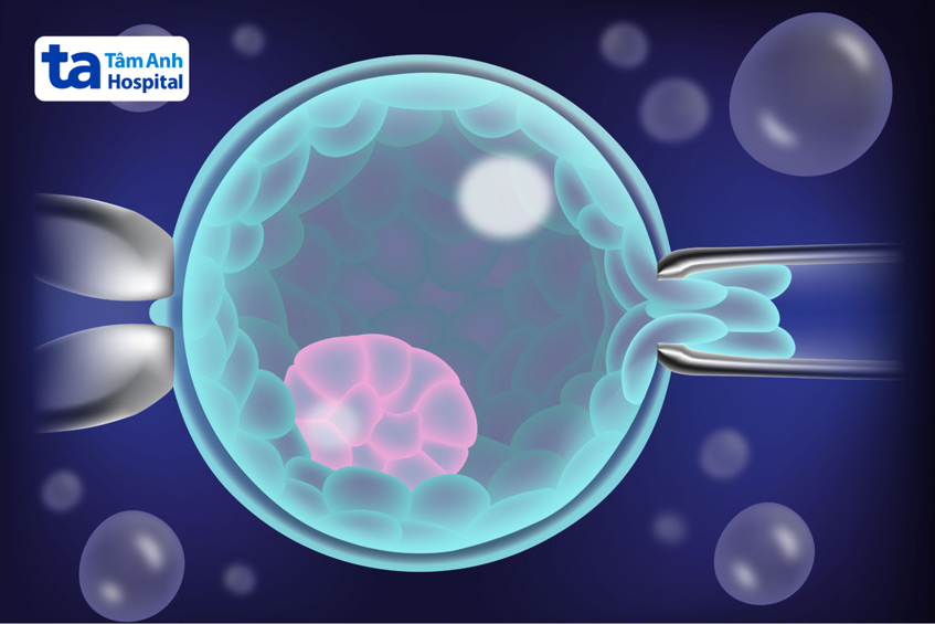 Chỉ định dùng phương pháp sàng lọc phôi nào được đưa ra dựa trên bệnh sử của vợ chồng vô sinh